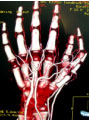 Hand-Chirurgie - Fehlbildungen Finger
