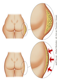 Fettpolster - Die Fettabsaugung (Liposuction) eignet sich zur Korrektur von Fettgewebsverteilungsstörungen am ganzen Körper. Nach Einspritzen von Tumeszenzlösung wird über Kanülen und eine Absaugpumpe das überschüssige Fettgewebe abgesaugt. Zur Nachbehandlung soll ein Kompressionsmieder getragen werden