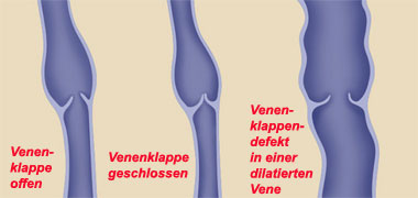 Venenklappen