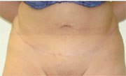 16 Wochen nach konturierender Liposuction, gro&szlig;er Bauchdeckenstraffung und innerer Korsage
