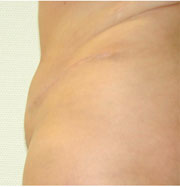 16 Wochen nach konturierender Liposuction, gro&szlig;er Bauchdeckenstraffung und innerer Korsage
