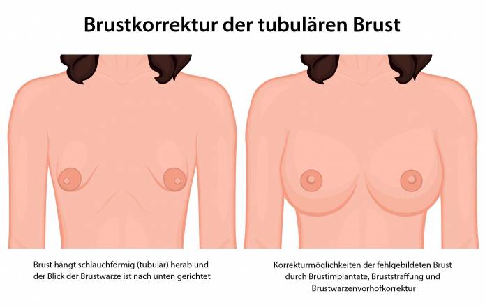Brustkorrektur der tubulären Brust