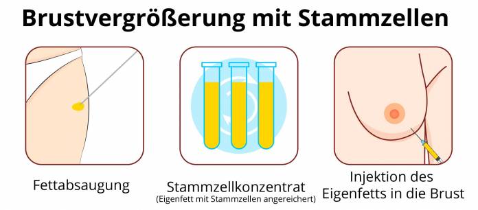 Brustvergrößerung mit Fettstammzellen