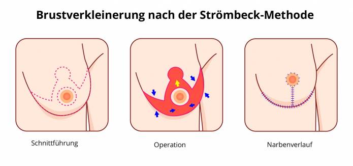 Brustverkleinerung