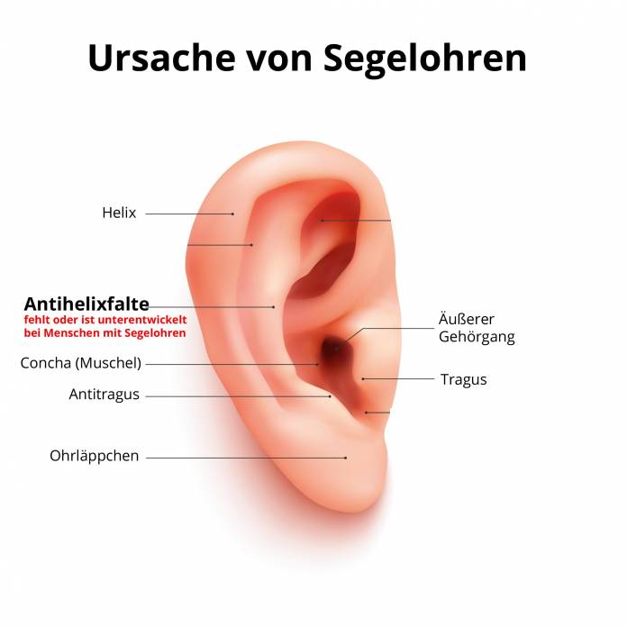 Häufigste Ursache abstehender Ohren