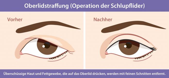 Oberlidstraffung (Operation der Schlupflider)