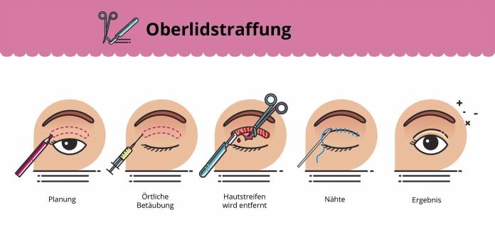 Oberlidstraffung