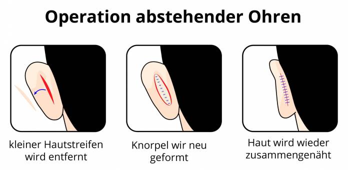 OP von abstehenden Ohren