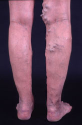 Krampfadern - Stammvarikosis am Knie