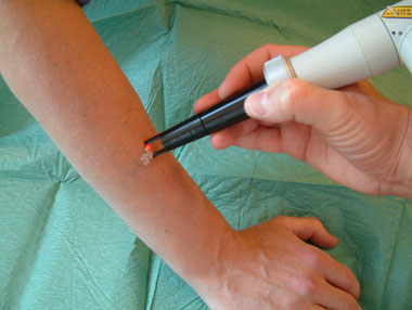 Tätowierung entfernen - Tatoo entfernen mit Laser