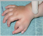 Hand-Chirurgie - Fehlbildungen Finger