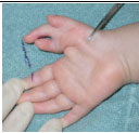 Hand-Chirurgie - Fehlbildungen Finger