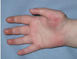 Hand-Chirurgie - Fehlbildungen Finger