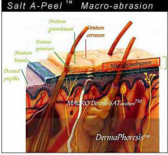 Abrasion - Macro-Dermabrasion