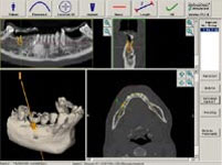 Simulation Zahnimplantation