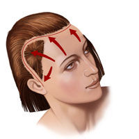 Beim Facelift wird das Unterhautgewebe im Gesicht gestrafft und überschüssige Haut entfernt. Man unterscheidet je nach Körperregion Stirnlift, Mid Face Lift und Halsstraffung. Die Eingriffe können teilweise auch endoskopisch durchgeführt werden.