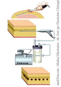 Plastische Chirurgie - fettabsaugung - Liposuction