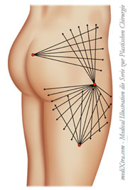 Bodylift, Gesäßstraffung