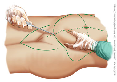 Fettabsaugung - Liposuction