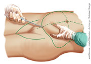 Fettabsaugung - Plastische Chirurgie
