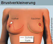 brustwarzen unterschiedlich groß