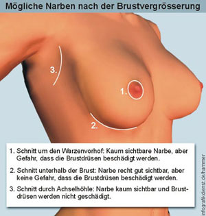 Brustvergrösserung - Plastische und Ästhetische Chirurgie
