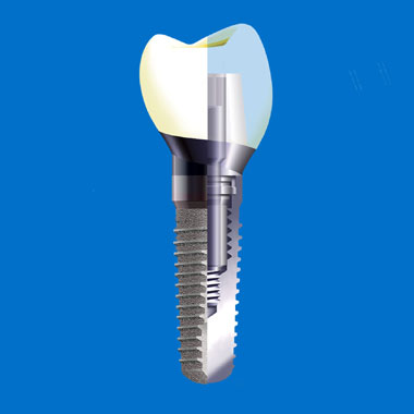 Implantatschnitt - Implantologie