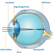 Lasik - Augenlaser - freraktive Chirurgie