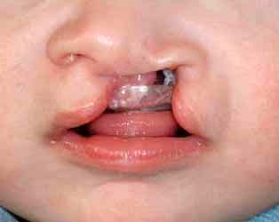 Vier Monate alter Säugling mit einseitiger Lippen-Kiefer-Gaumen-Spalte. Das Kind wurde an der Würzburger Uniklinik mit einer so genannten Platte versorgt, welche die Kiefer-Gaumenspalte abdeckt und der Wachstumssteuerung des Kiefers dient