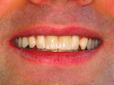 Frontzahnengstand - kosmetische Zahnmedizin