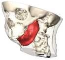 Mund-, Kiefer- und Gesichtschirurgie: Numerische Modellierung des Gesichts für eine optimale Operationsplanung