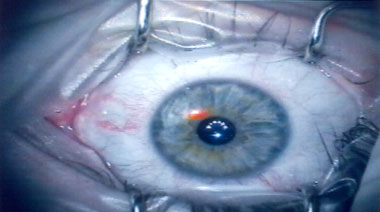 Lasik - Augenlaser OP