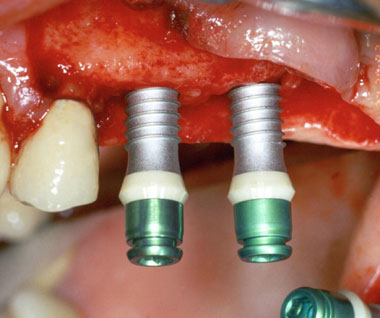 2 Hybridimplantate mit weissem Zirkoniumrand