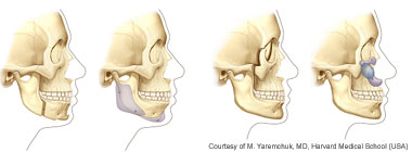 Gesichtsimplantate simulieren Knochenverlagerungen (Osteotomien)