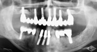 Nach der Behandlung: Aufgebauter Kieferknochen