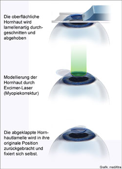 Lasik - Refraktive Chirurgie