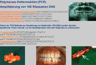 Parodontitis-Bakterien als Ursache von Arteriosklerose