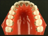 Gesunde und schöne Zähne +++ kieferorthopädische Korrektur ermöglicht Erhalt gesunder Zähne