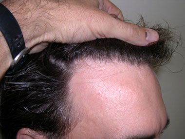 Haarausfall, Haartransplantation, Haarverpflanzung