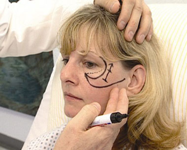 Ilka vor ihrem Facebrightening. Der Arzt markiert mit Filzstift, wo er schneiden wird - ZDF-Reportage
